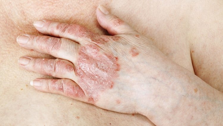 La psoriasis es una enfermedad autoinmune que puede afectar a la piel provocando brotes y sarpullidos que la lesionan