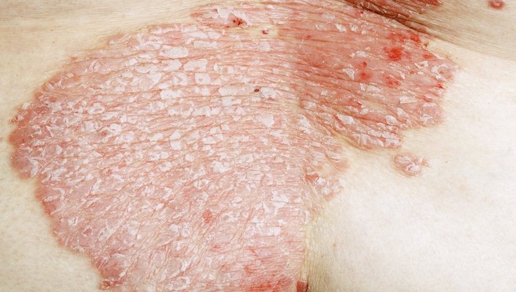 Los brotes más evidentes de la psoriasis se manifiestan en el cuello, codos o rodillas