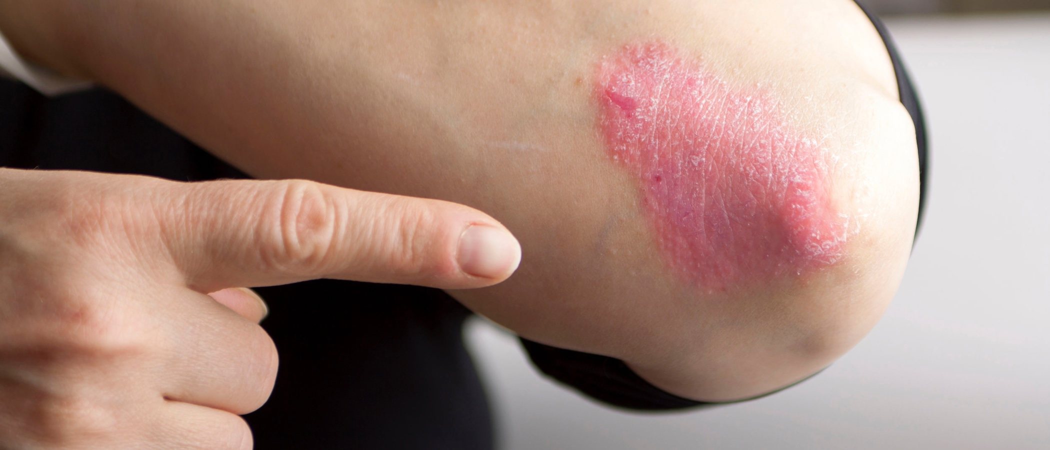 Cómo maquillarse con un brote de psoriasis