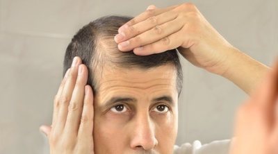 ¿Qué es la foliculitis decalvante?