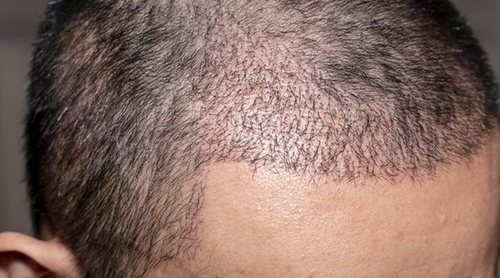 Ventajas e incovenientes de los injertos de pelo