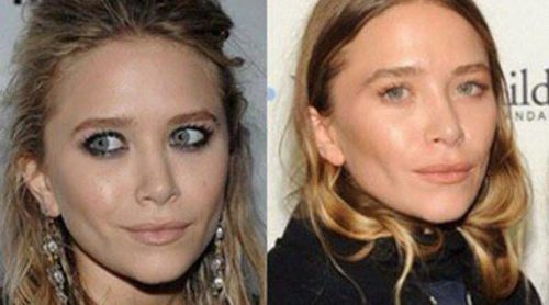 Mary-Kate Olsen y otras famosas que se operaron radicalmente el rostro