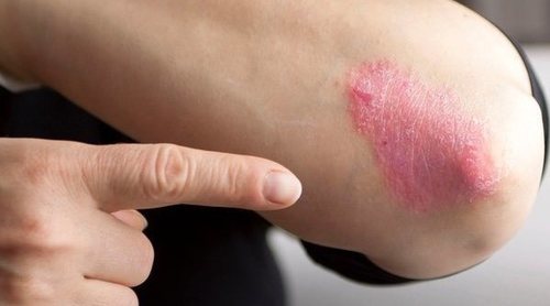 Cómo maquillarse con un brote de psoriasis