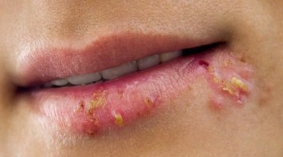 ¿Por qué salen calenturas en los labios?